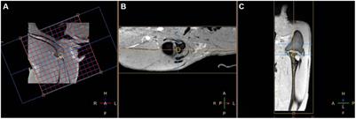 Fast field echo resembling a CT using restricted echo-spacing (FRACTURE) sequence for shoulder joint in normal dogs